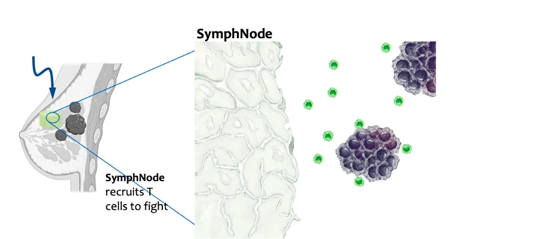 Step 1 diagram: SymphNode is implanted beside a breast tumor. A magnified view shows the empty porous scaffold next to tumor cells surrounded by regulatory T cells.